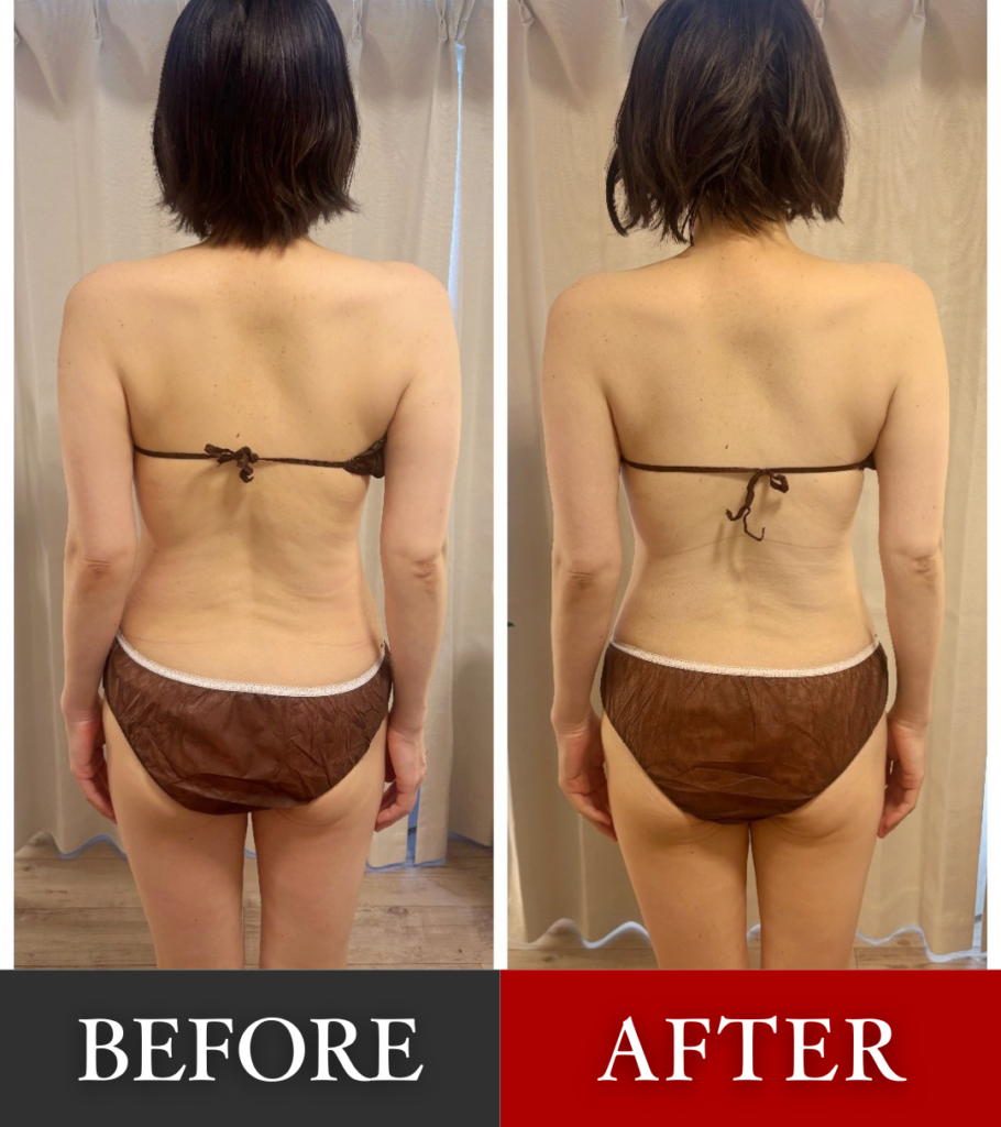 「ハンドセラピスで、ここまで体は変わる」そのことを伝えたく、
このBeforeAfterを応募しました。
この方は、
✔ 左右の肩の高さの違い
✔ 肩甲骨の位置のズレ
✔ 体幹のねじれによるウエストラインの左右差
といった、全身の歪みが見られました。
施術で最も意識したのは、背骨まわりと肩甲骨まわりの筋肉を丁寧に緩めました。
ハンドセラピスの微弱電流と素手による施術で、肩甲骨の動きを妨げていた緊張を解放し、
背骨と肩甲骨が連動して動ける状態を意識して、施術しました。
その結果、一回の施術でも背骨と肩甲骨の可動が引き出されたことで体幹のねじれが軽減し、歪みの改善とともに、ウエストラインの左右差が整いました。
形を整えるのではなく、体が整うための土台から整える。
それがハンドセラピスのすごいところだと感じています。