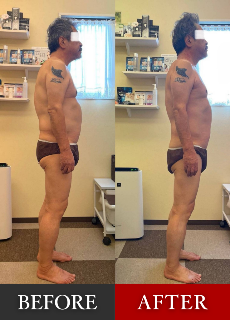 頸椎骨化症
60代、自営業、男性
首の骨が硬まる難病
とにかく筋肉が硬く首肩周りが丸くなり
常に痛い
ハンドセラピスをすると本当に楽になる
初回は週に１度の頻度で来店
3年目になるが今でも週１度か2週に１度の頻度で来店